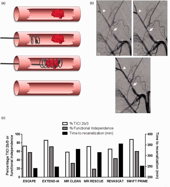Fig. 1. Illustration of endovascular thrombectomy after acute ischemic stroke.